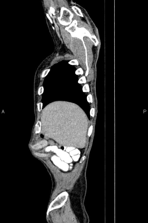 Ampullary adenocarcinoma (Radiopaedia 86093-102033 E 7).jpg