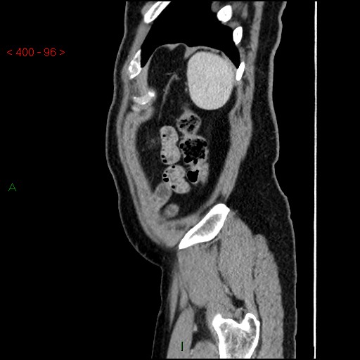 Ampullary carcinoma (Radiopaedia 56396-63056 D 95).jpg