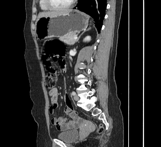 File:Ampullary tumor (Radiopaedia 60333-67998 C 37).jpg