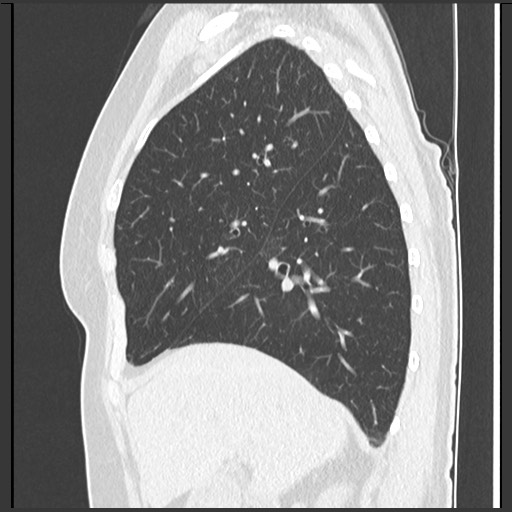 File:Amyloidosis - bronchial and diffuse nodular pulmonary involvement (Radiopaedia 60156-67744 F 18).jpg