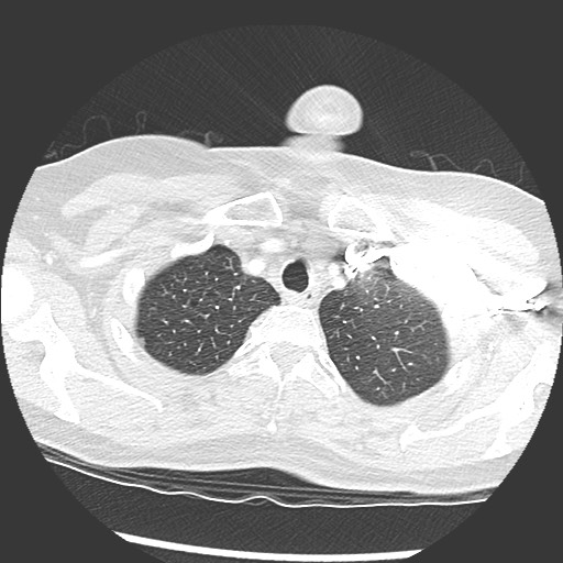 Amyloidosis - bronchial and diffuse nodular pulmonary involvement (Radiopaedia 60156-67745 Axial lung window 8).jpg