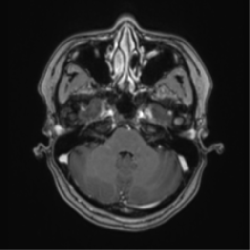 Anaplastic astroblastoma (Radiopaedia 55666-62194 Axial T1 C+ 18).png