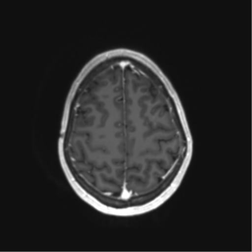 File:Anaplastic astrocytoma IDH mutant (Radiopaedia 50046-55341 Axial T1 C+ 40).png