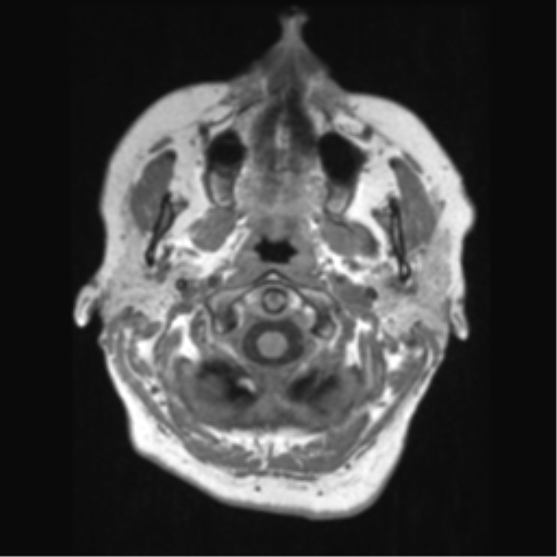 File:Anaplastic astrocytoma IDH wild-type (pseudoprogression) (Radiopaedia 42209-45276 Axial T1 14).png