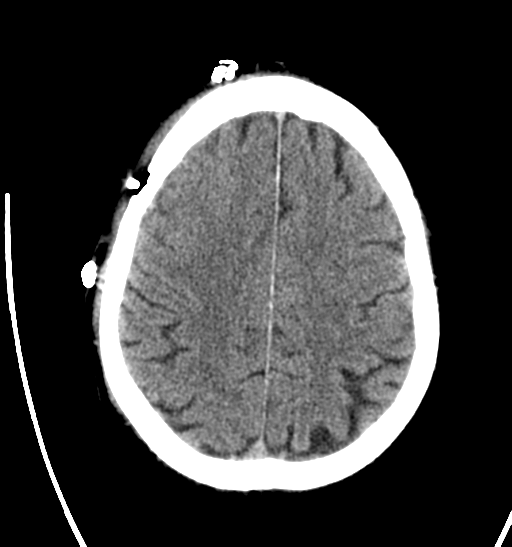 File:Anaplastic meningioma with recurrence (Radiopaedia 34452-35786 Axial non-contrast 24).png