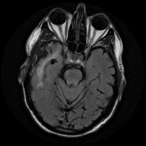 File:Anaplastic meningioma with recurrence (Radiopaedia 34452-35790 Axial T2 FLAIR 7).png