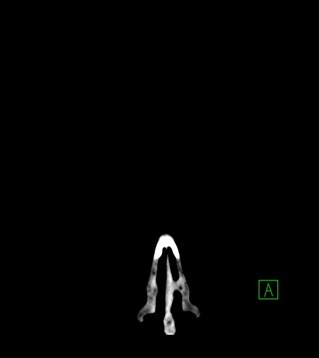 Anaplastic oligodendroglioma (Radiopaedia 79571-92753 Coronal non-contrast 7).jpg