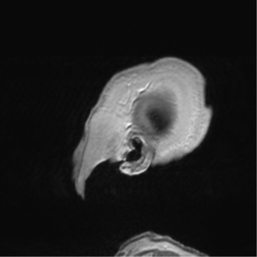 Anaplastic oligodendroglioma (Radiopaedia 83500-98599 Sagittal T1 C+ 60).png