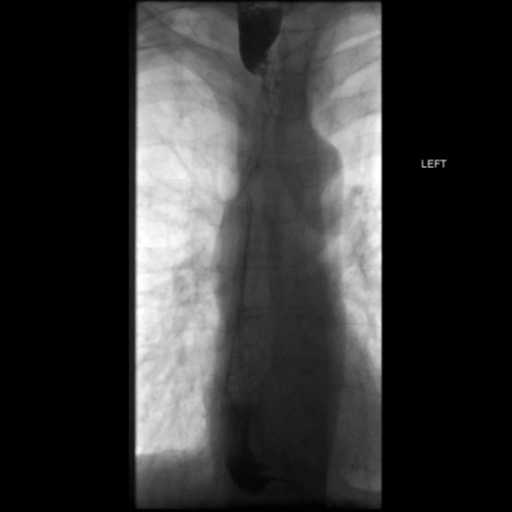 File:Anastomotic stricture post Ivor Lewis esophagectomy (Radiopaedia 47937-52715 B 30).png