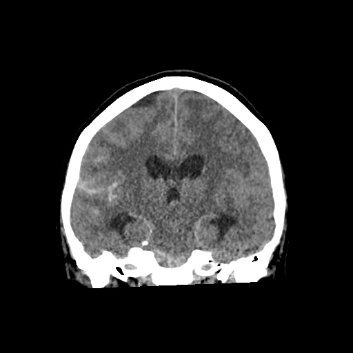Aneursym related subarachnoid hemorrhage with hydrocephalus (Radiopaedia 45105-49083 Coronal non-contrast 35).jpg