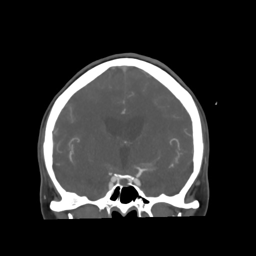 Aneursym related subarachnoid hemorrhage with hydrocephalus (Radiopaedia 45105-49084 B 36).jpg