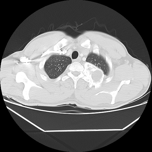 File:Aneurysmal bone cyst - rib (Radiopaedia 82167-96220 Axial lung window 16).jpg