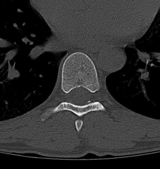 Aneurysmal bone cyst T11 (Radiopaedia 29294-29721 Axial bone window 15).jpg