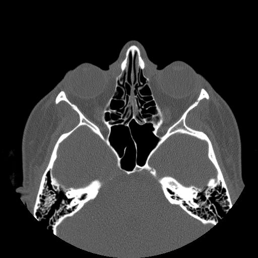 Aneurysmal bone cyst of the mandible (Radiopaedia 43280-46823 Axial bone window 163).jpg