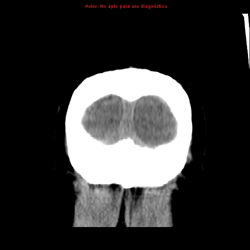 File:Aneurysmal subarachnoid hemorrhage (Radiopaedia 24740-24997 Coronal non-contrast 47).jpg