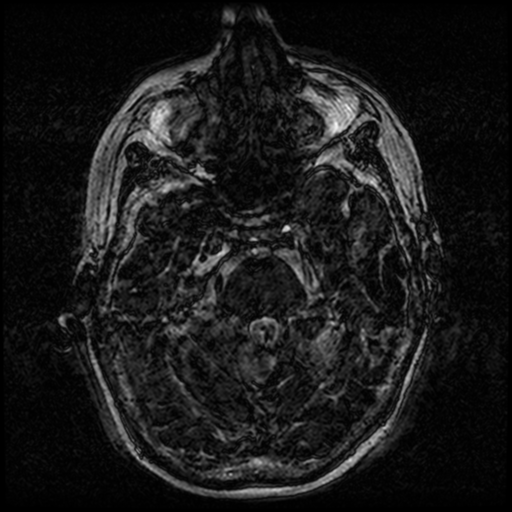 Angioinvasive aspergillosis in the pituitary fossa (Radiopaedia 39676-42010 Ax 3D FIESTA VOLUME 32).png