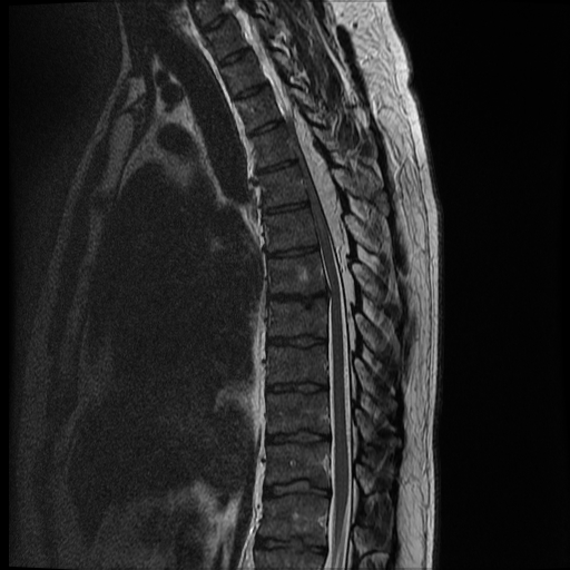 File:Angiolipoma - thoracic spine (Radiopaedia 28242-28479 Sagittal T2 8).jpg