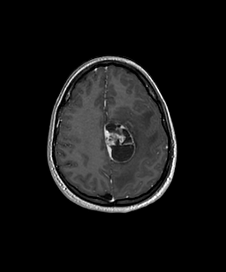 Angiomatous meningioma (Radiopaedia 79459-92577 Axial T1 C+ 3D ISO 33).jpg