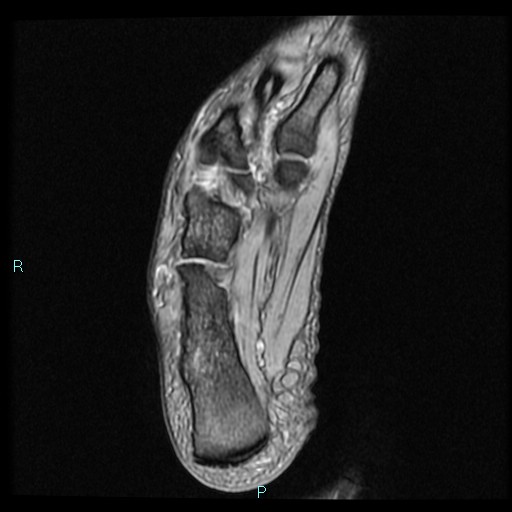 Ankle ganglion cyst (Radiopaedia 62809-71162 Axial Gradient Echo 15).jpg
