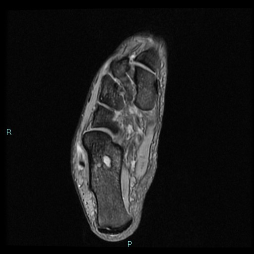 Ankle ganglion cyst (Radiopaedia 62809-71162 Axial Gradient Echo 26).jpg
