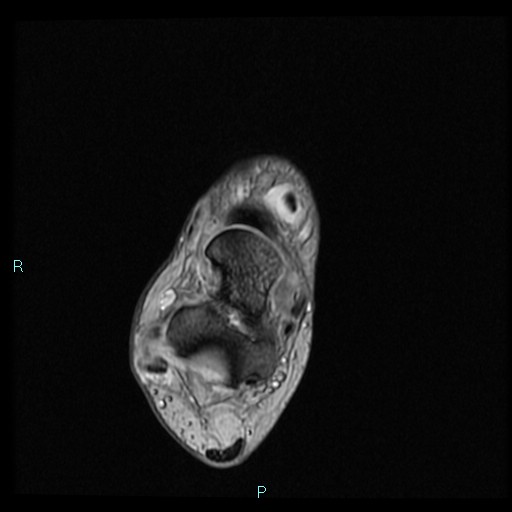 Ankle ganglion cyst (Radiopaedia 62809-71162 Axial Gradient Echo 47).jpg