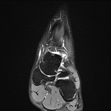 Ankle syndesmotic injury (Radiopaedia 69066-78837 Coronal PD fat sat 41).jpg