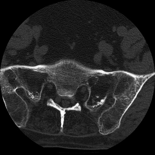 Ankylosing spondylitis complicated by fracture-dislocation (Radiopaedia 33583-34674 Axial non-contrast 160).jpg