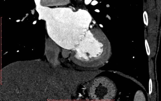 Anomalous left coronary artery from the pulmonary artery (ALCAPA) (Radiopaedia 70148-80181 B 182).jpg