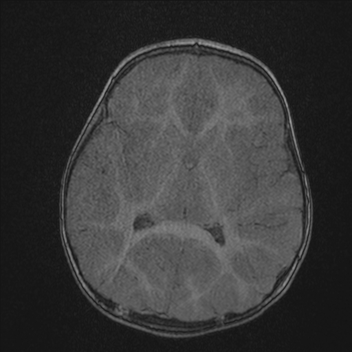 Anoxic brain injury (Radiopaedia 79165-92139 Axial MRA 132).jpg