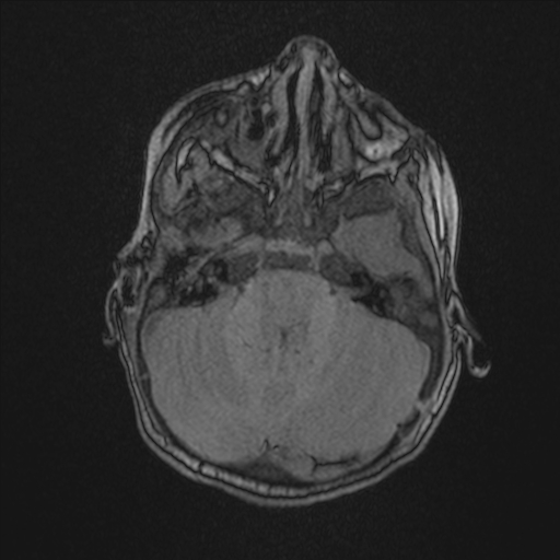 Anoxic brain injury (Radiopaedia 79165-92139 Axial MRA 56).jpg