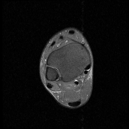 File:Anterior calcaneal process fracture (Radiopaedia 71377-81705 Axial PD fat sat 3).jpg