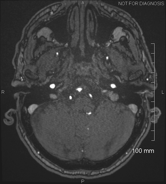 Anterior cerebral artery aneurysm (Radiopaedia 80683-94127 Axial MRA 39).jpg