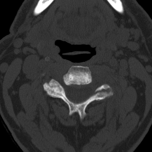 Anterior cervical postdiscectomy arthrodesis (Radiopaedia 32678-33646 Axial bone window 30).jpg