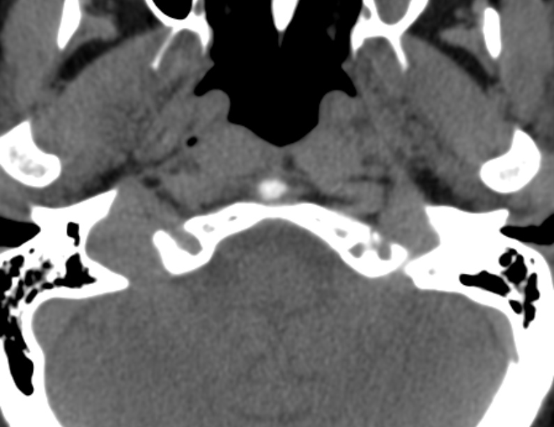 Anterior cervical postdiscectomy arthrodesis (Radiopaedia 32678-33646 Axial non-contrast 4).jpg