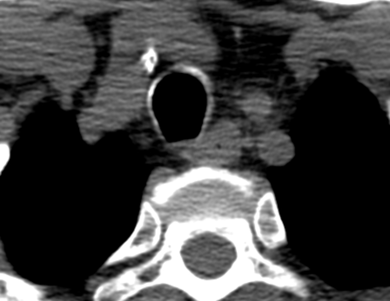 Anterior cervical postdiscectomy arthrodesis (Radiopaedia 32678-33646 Axial non-contrast 75).jpg
