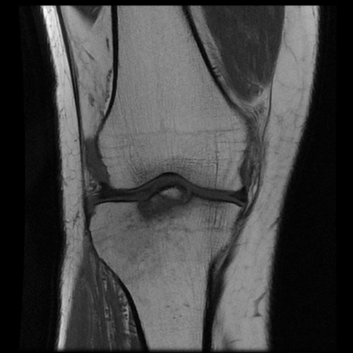 File:Anterior cruciate ligament avulsion fracture (Radiopaedia 58939-66193 Coronal T1 9).jpg
