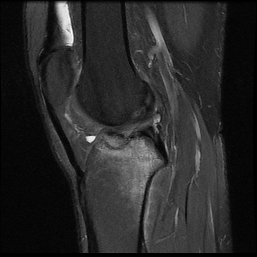 File:Anterior cruciate ligament avulsion fracture (Radiopaedia 58939-66193 Sagittal PD fat sat 10).jpg