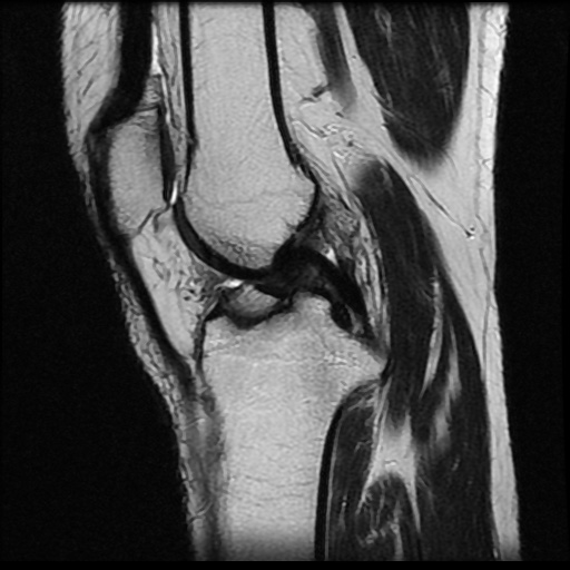 File:Anterior cruciate ligament avulsion fracture (Radiopaedia 58939-66193 Sagittal T2 12).jpg