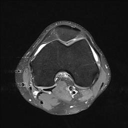 File:Anterior cruciate ligament full thickness tear (Radiopaedia 66268-75467 Axial PD fat sat 12).jpg
