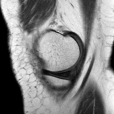 File:Anterior cruciate ligament mucoid degeneration (Radiopaedia 60853-68633 Sagittal T1 7).jpg