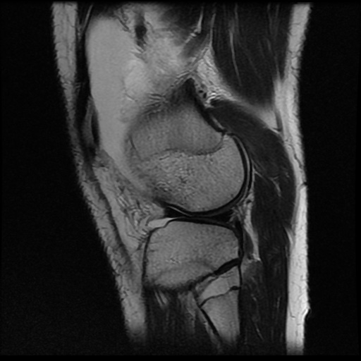 File:Anterior cruciate ligament tear (Radiopaedia 61500-69462 Sagittal T2 16).jpg