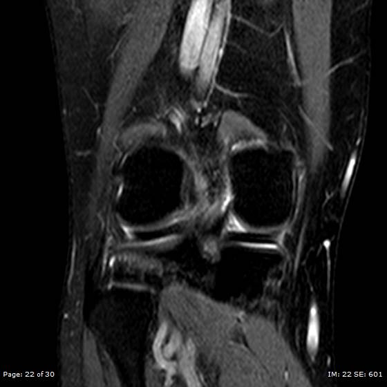 File:Anterior cruciate ligament tear (Radiopaedia 70783-80964 Coronal STIR 22).jpg