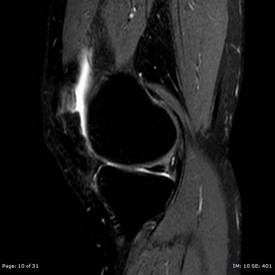 File:Anterior cruciate ligament tear (Radiopaedia 70783-80964 Sagittal STIR 10).jpg