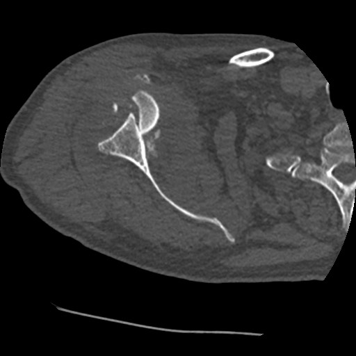 File:Anterior glenohumeral dislocation with Hill-Sachs lesion (Radiopaedia 62877-71249 Axial bone window 34).jpg