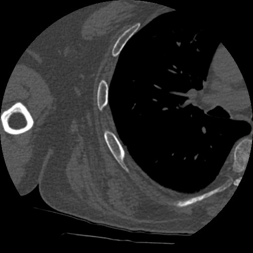 Anterior glenohumeral dislocation with Hill-Sachs lesion (Radiopaedia 62877-71249 Axial bone window 89).jpg
