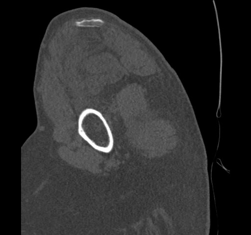 Anterior glenohumeral dislocation with Hill-Sachs lesion (Radiopaedia 62877-71249 Sagittal bone window 20).jpg