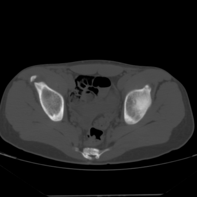Anterior inferior iliac spine avulsion fracture (Radiopaedia 49469-54627 Axial bone window 31).jpg