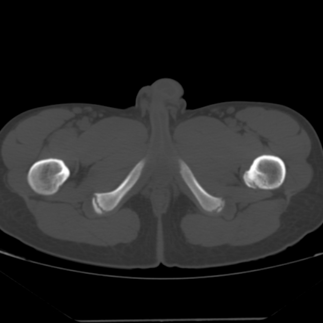 Anterior inferior iliac spine avulsion fracture (Radiopaedia 49469-54627 Axial bone window 59).jpg