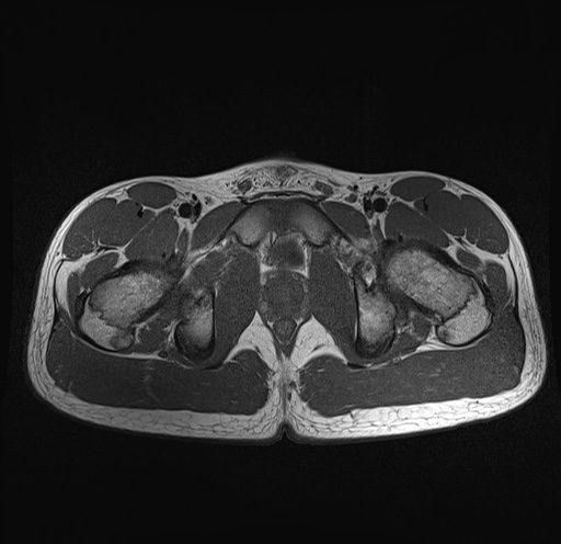 File:Anterior inferior iliac spine avulsion fracture (Radiopaedia 81312-95000 Axial T1 10).jpg