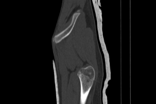 Anterior inferior iliac spine avulsion injury (Radiopaedia 88666-105376 Sagittal bone window 15).jpg